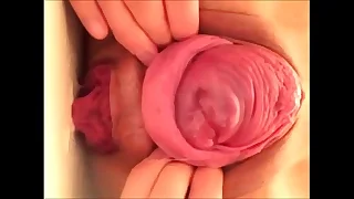 japanese prolapse